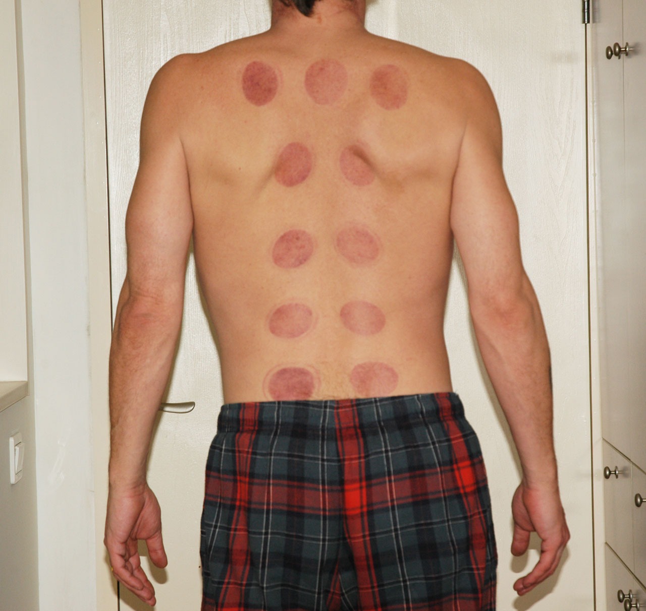 The Secret Behind The Cupping Cure