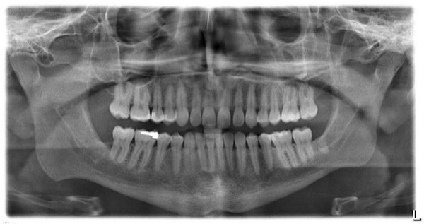 The Real 50 Shades of Grey – Understanding Dental X-rays