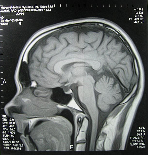 Dissecting Brain Injuries: An Epidural Hematoma