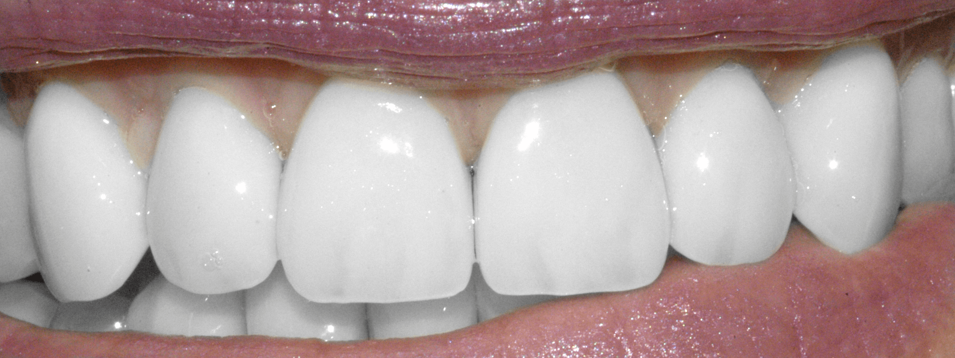 Grinding Those Teeth: Bruxism