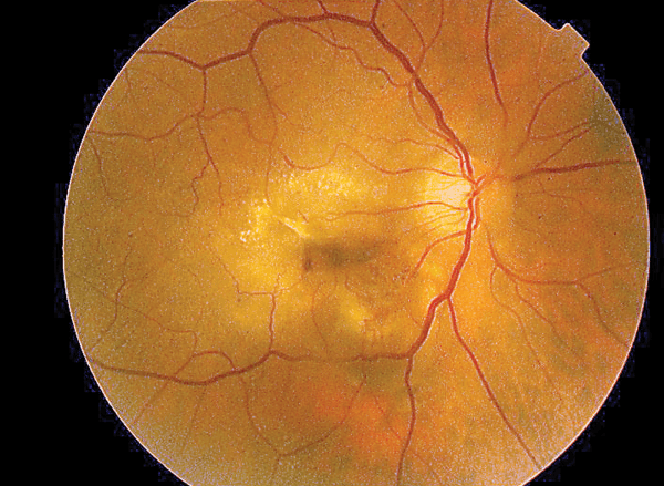 Genes and Age-Related Macular Degeneration