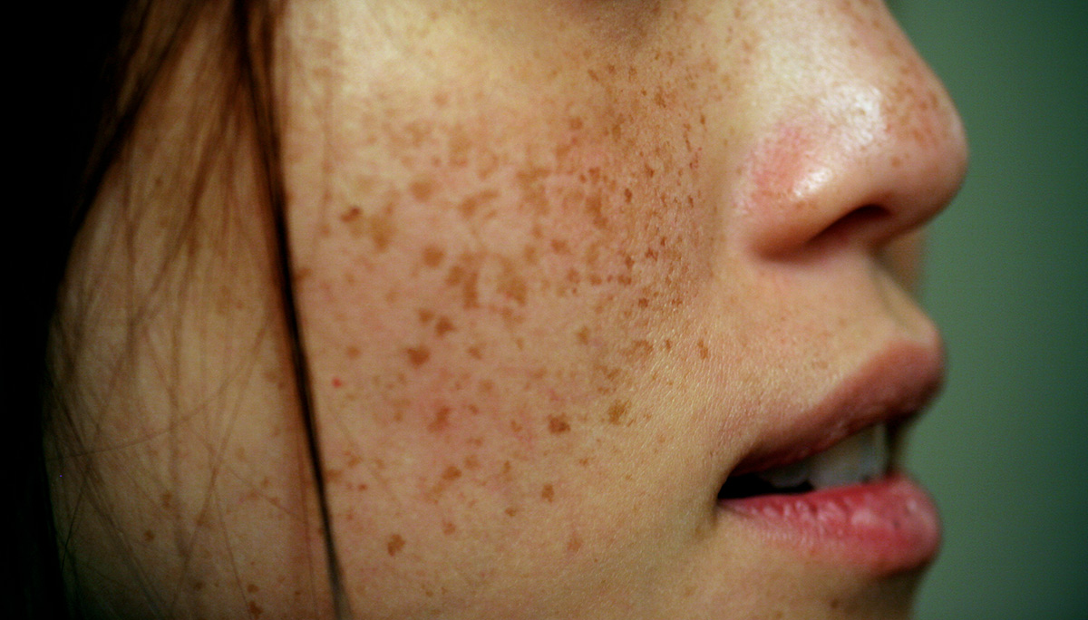Summer Spotlight: Freckles