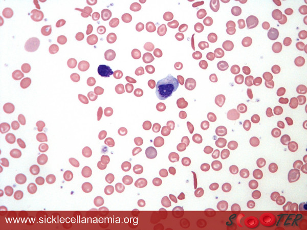 Curing Sickle Cell Disease