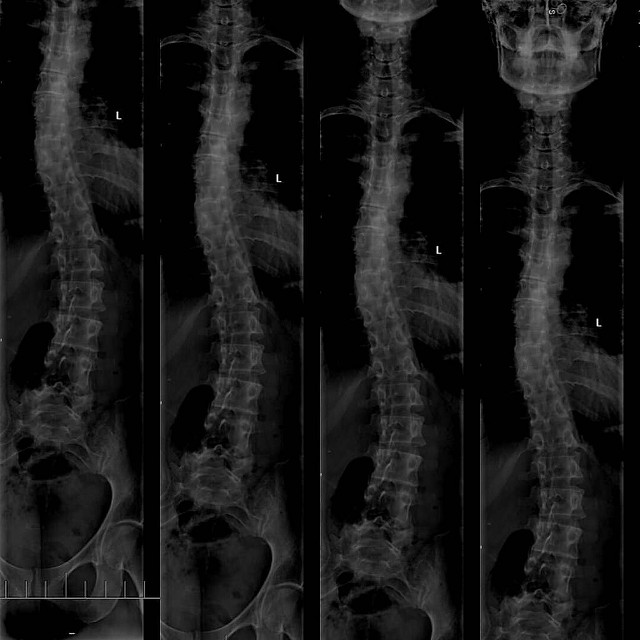 Scoliosis Spelled Out