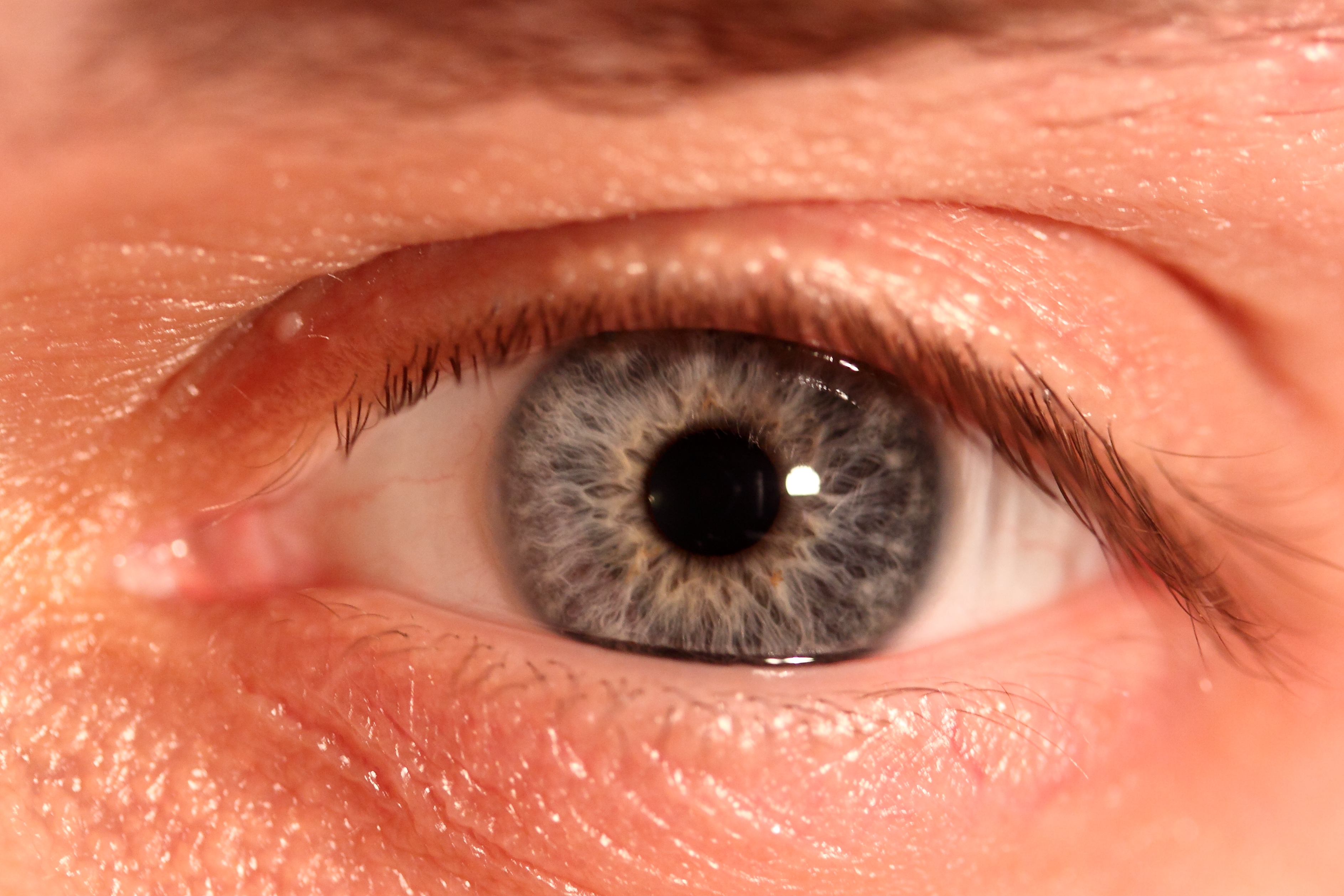 Глаукома зеленые глаза