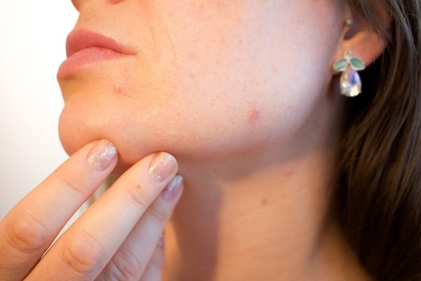 Natural Acne Treatment