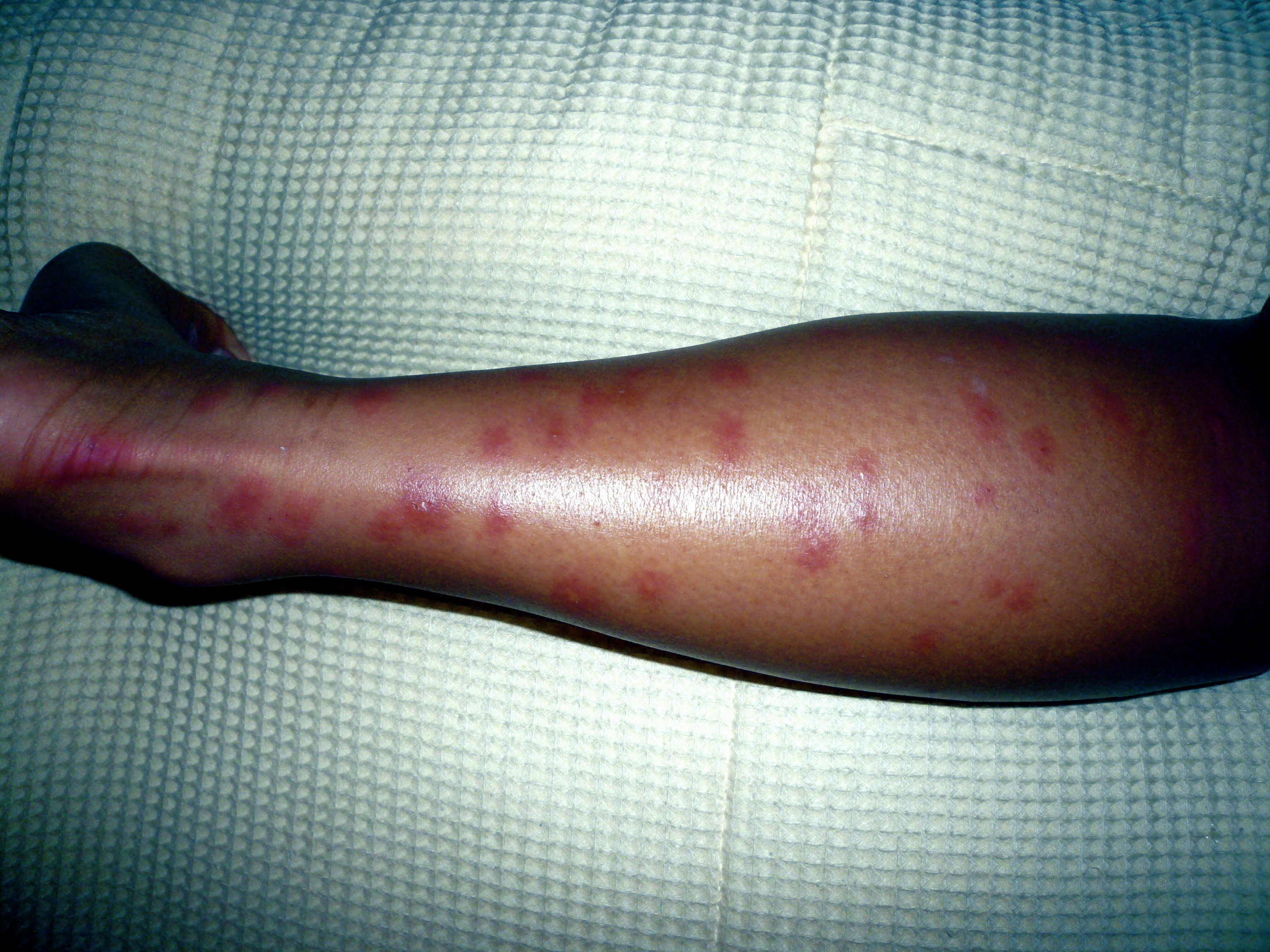 Getting Under the Skin: Pityriasis Lichenoides