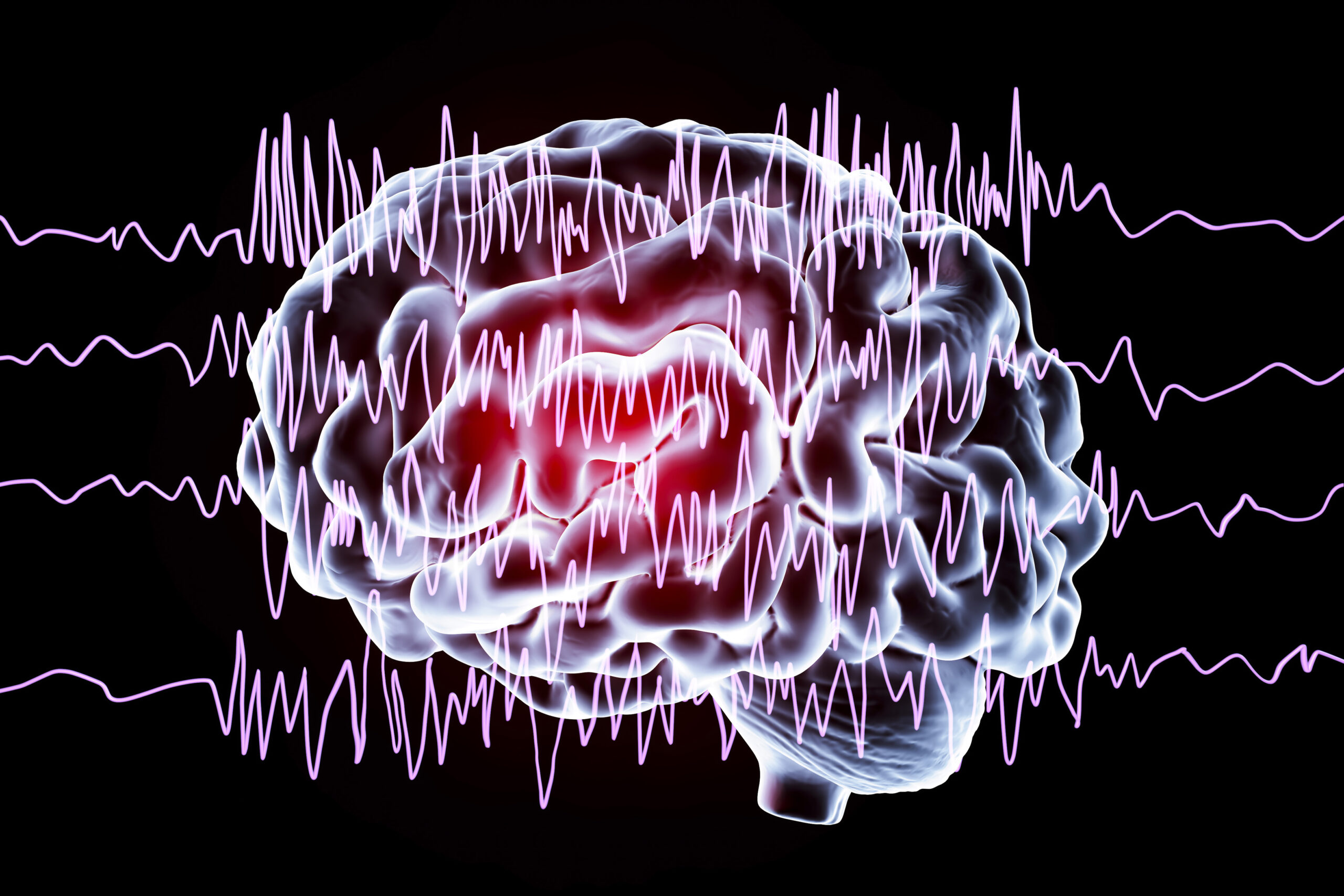 Ending Epilepsy: New Findings Can Potentially Stop Seizures Before They Start