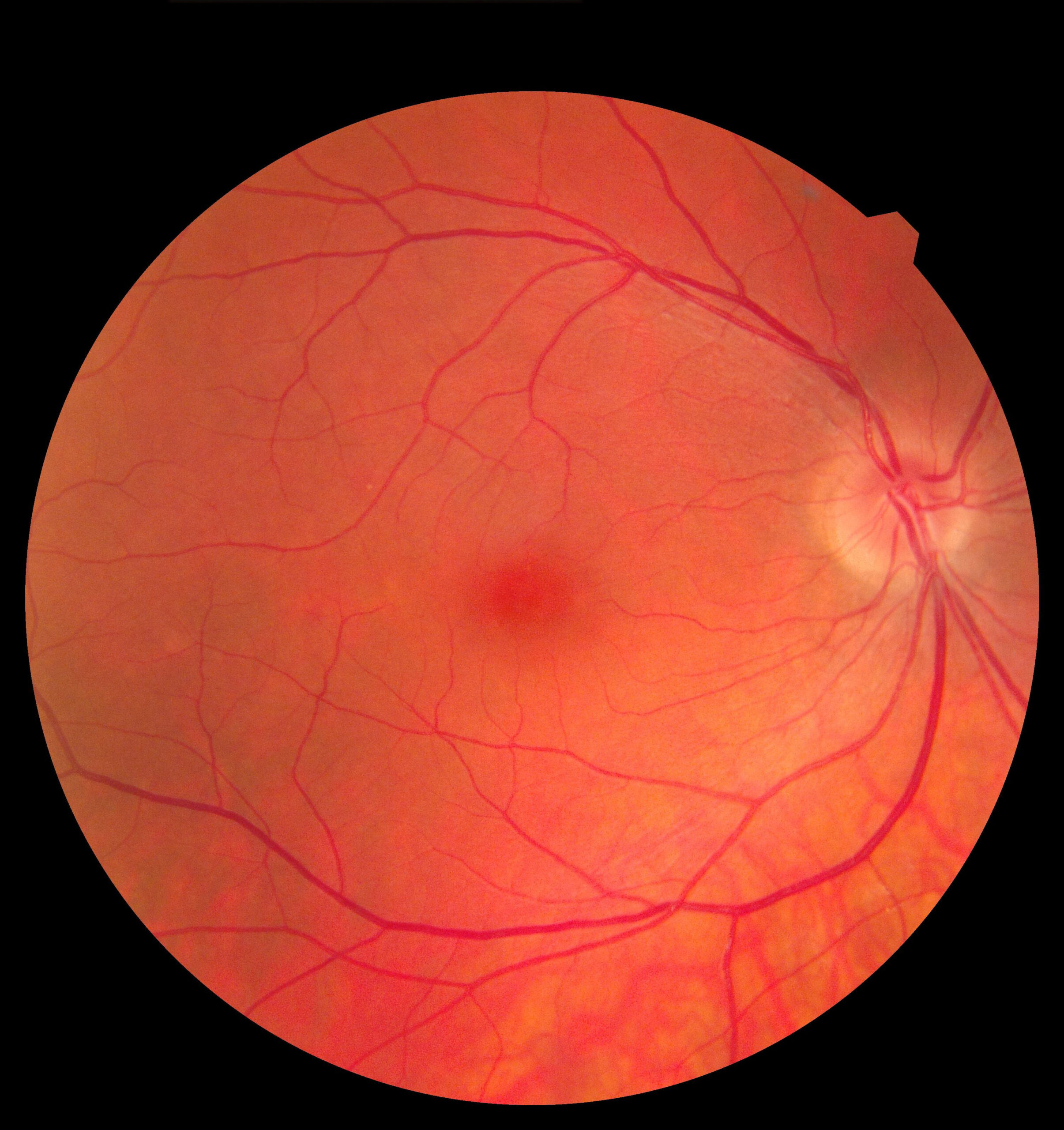 Age-Related Macular Degeneration and COVID-19: How Are They Related?