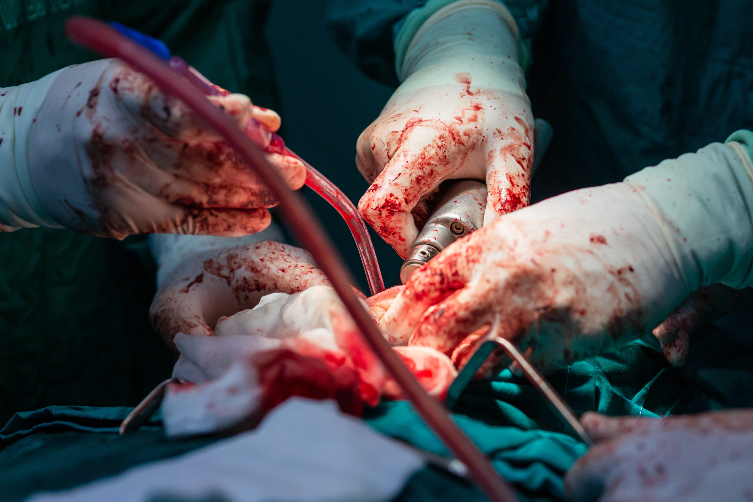 Seconds to Survive: How Hemorrhage Becomes Trauma’s Greatest Threat