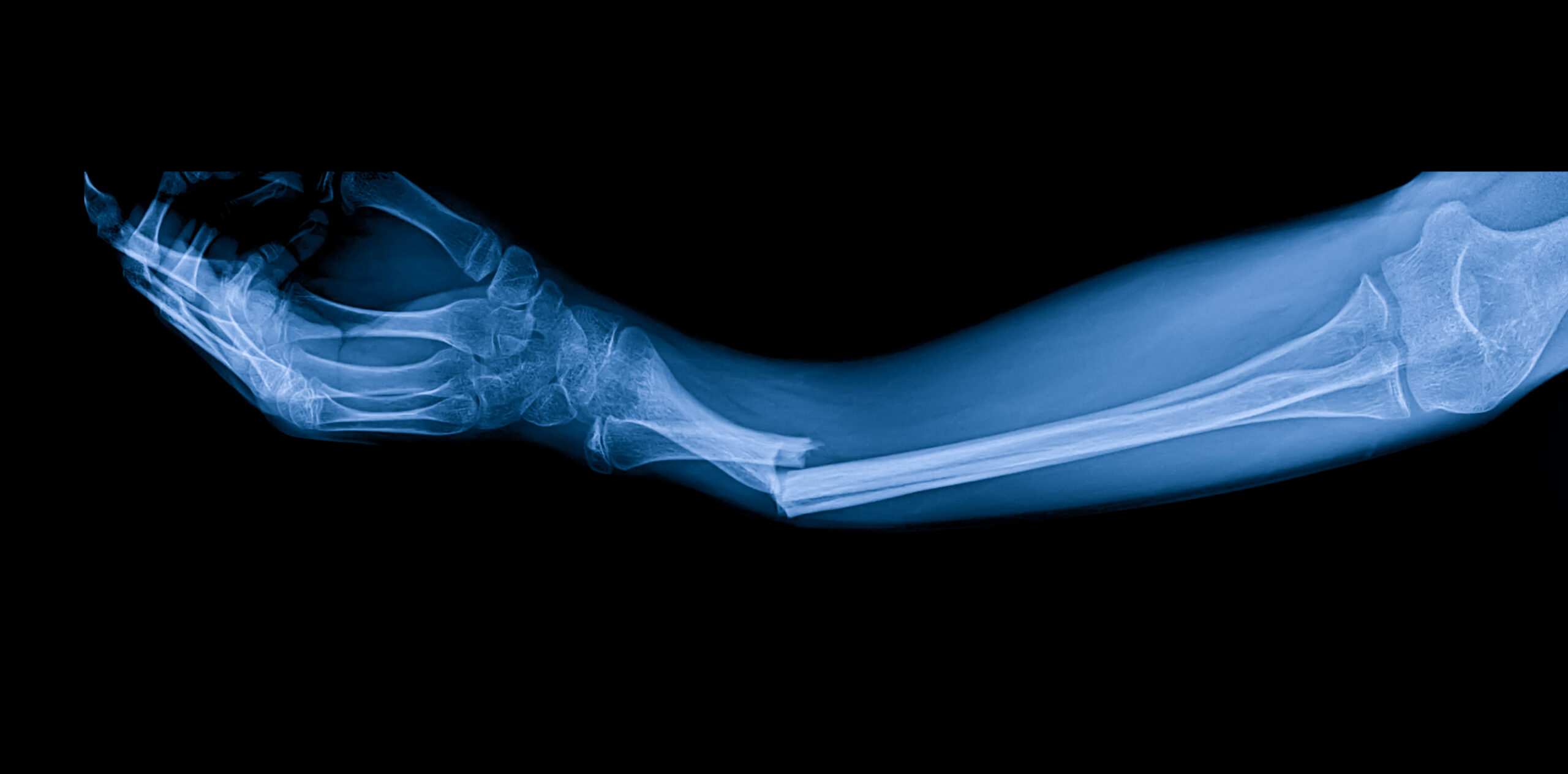 Bones to Breaks: What Drives America’s Most Common Fractures