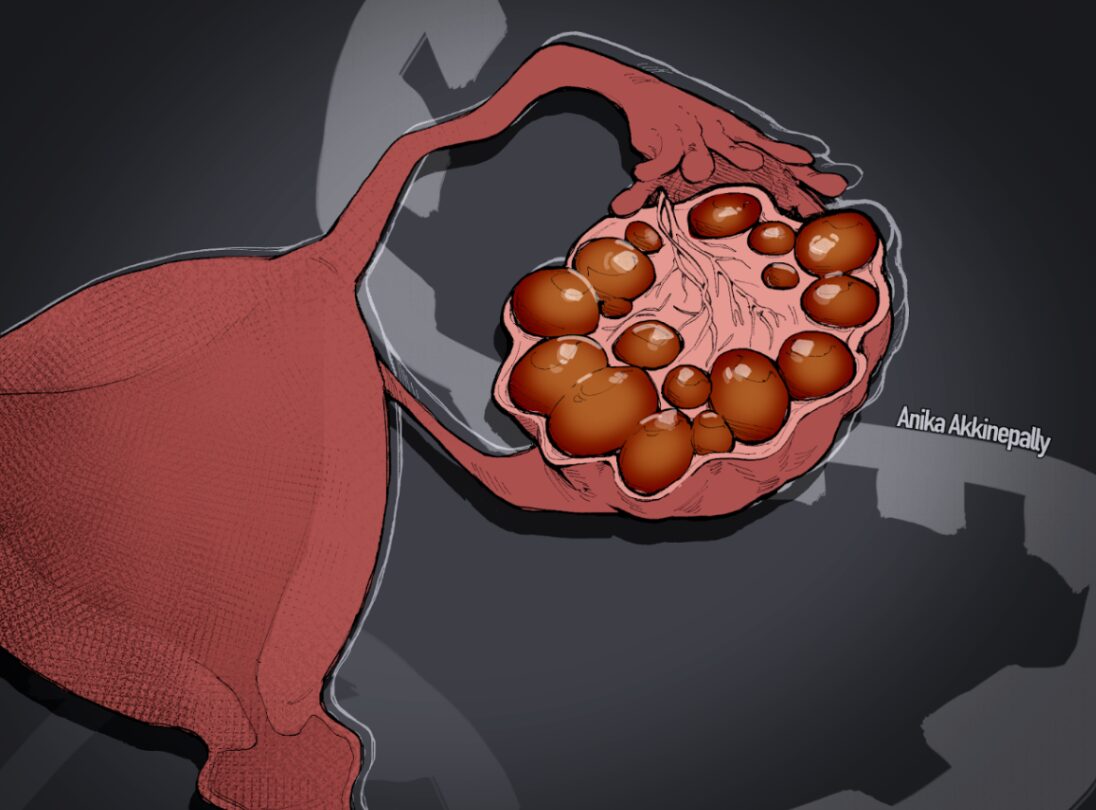[UCSD Winning Article] MicroRNAs: A New Hope For PCOS Patients